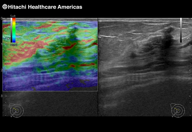 Breast Lesion Elastography