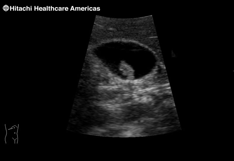 Gall Bladder NonShadowing Stone Zoom