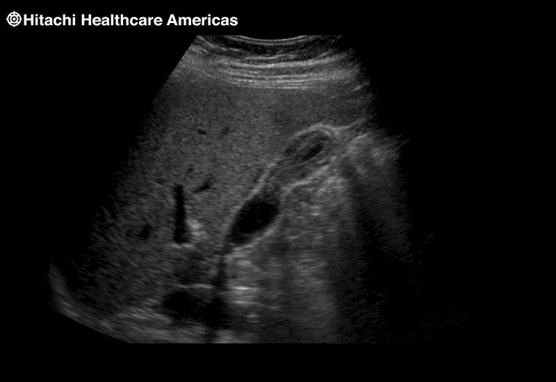 Gall Bladder Thickened Wall