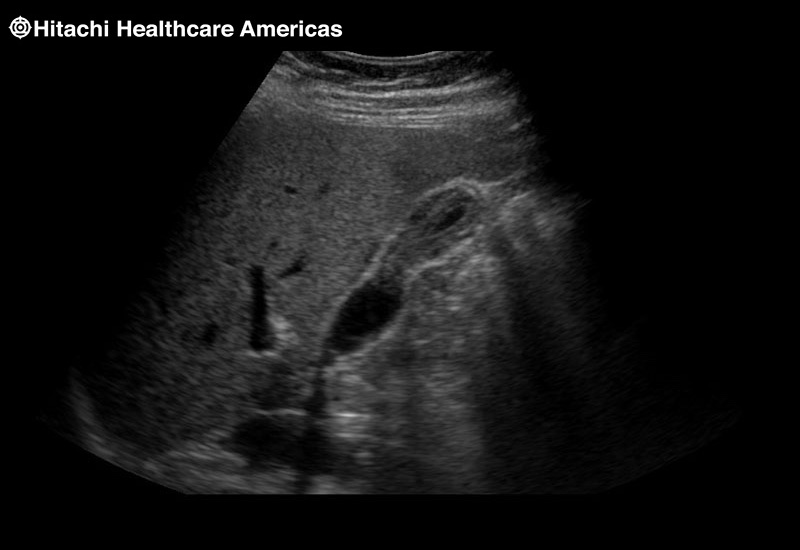 Gall Bladder Thickened Wall