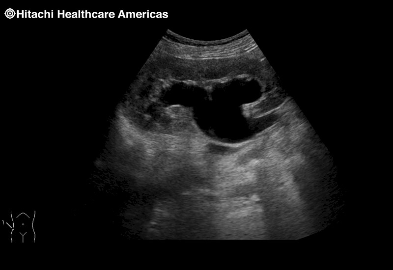 Kidney Hydronephrosis