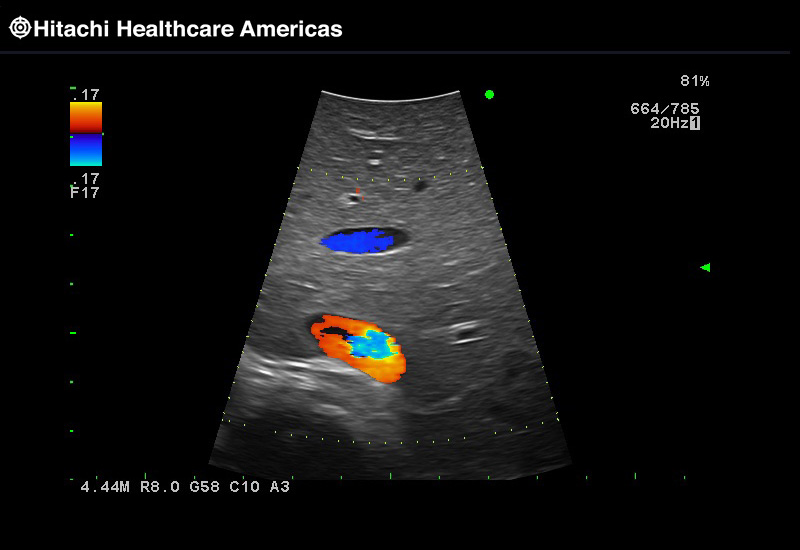 Liver Color Doppler