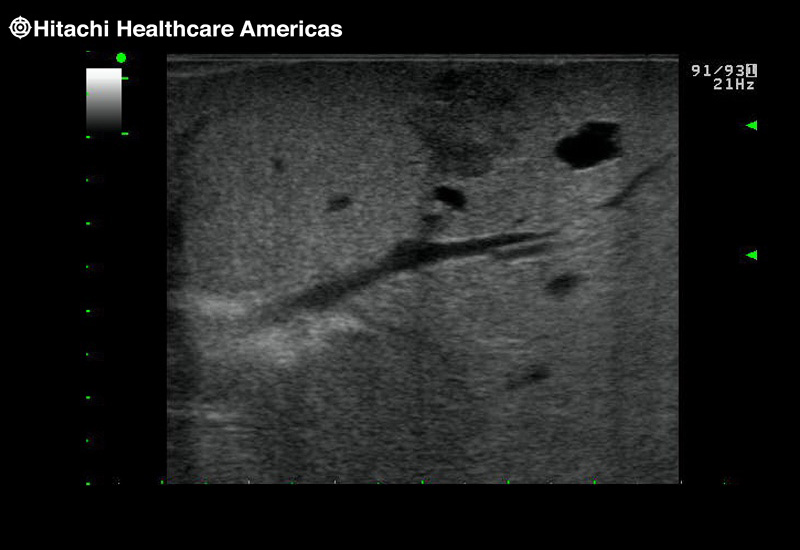 Liver Mild Hepatocellular Disease