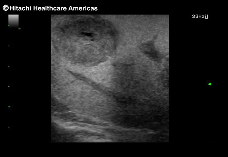 Liver Moderate Hepatocellular Disease