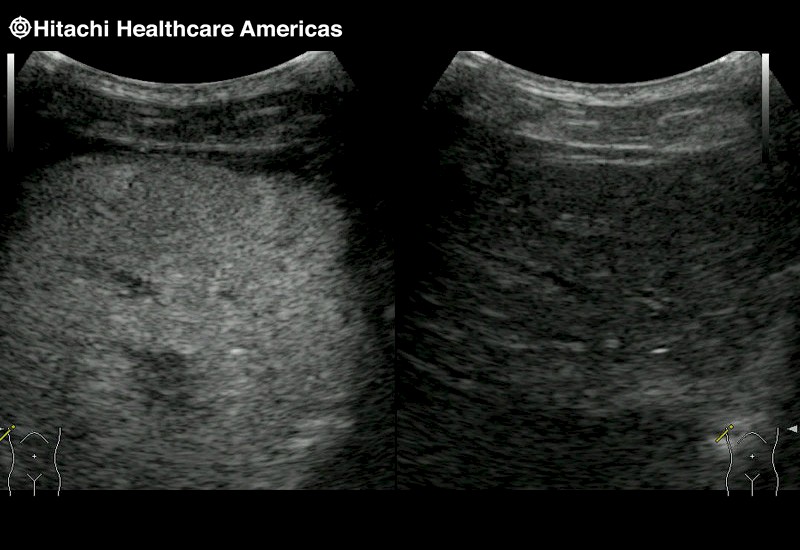 Liver Lesion Contrast