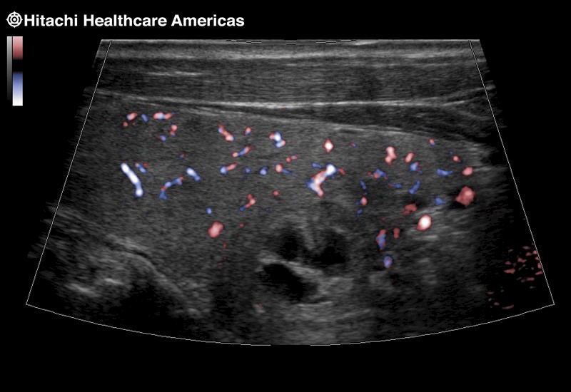 Thyroid Trapezoid eFlow