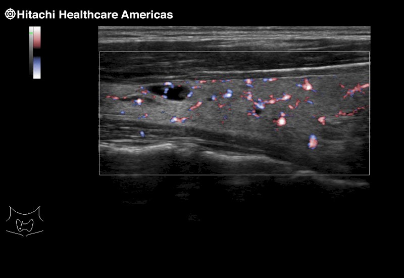 Thyroid Cyst eFlow