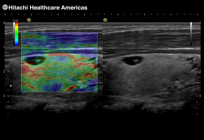 Thyroid Elastography
