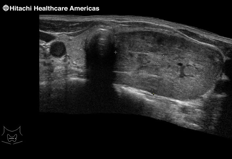 Thyroid Lesion Extended Field of View EFV