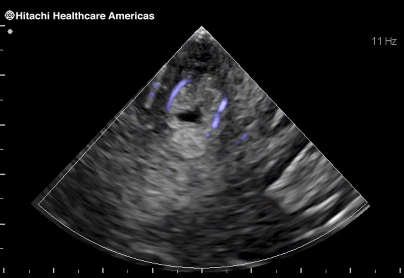 Brain Tumor with Blood Flow