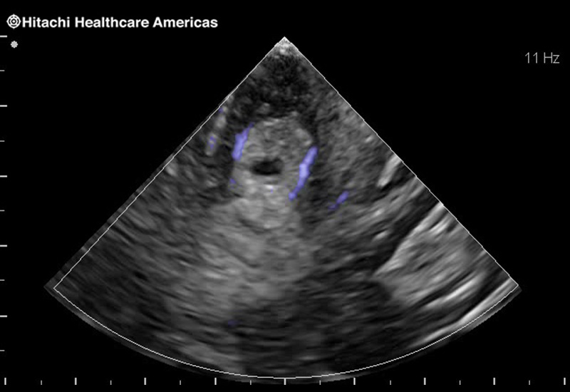 Brain Tumor with Blood Flow