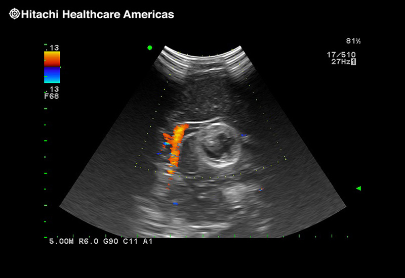 Brain Tumor with Blood Flow