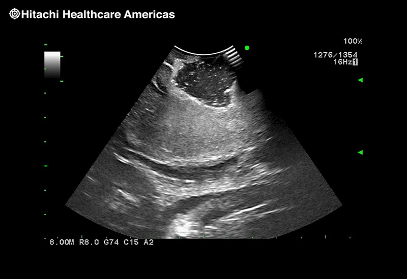 Post Disection Cavity