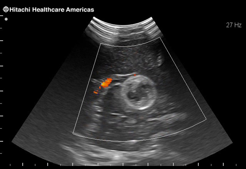 Brain Tumor with Blood Flow