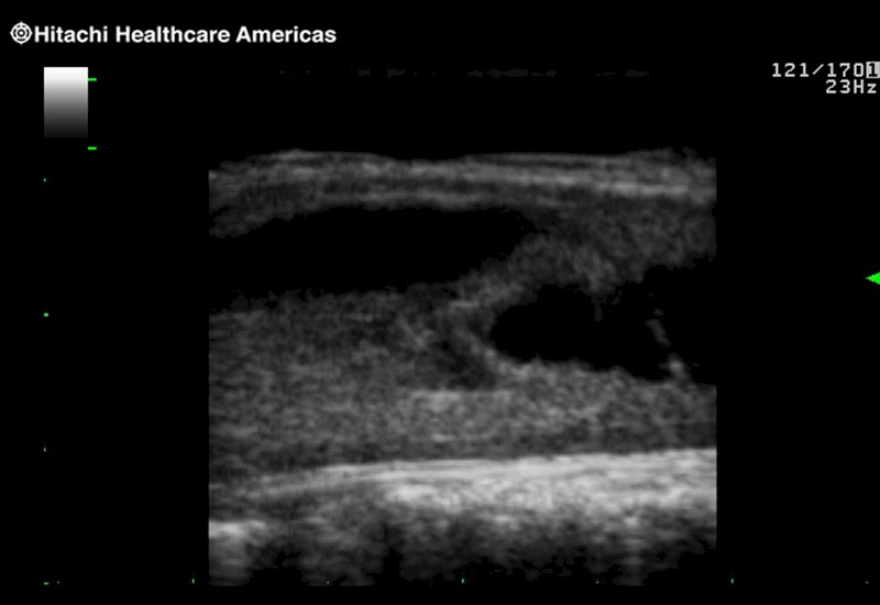 Spinal Cord Complex Tumor of Thoracic Spinal Cord