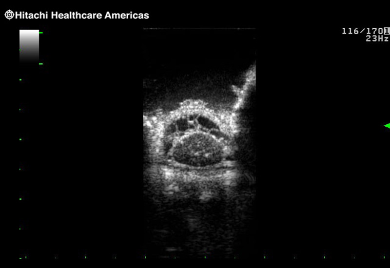 Spinal Cord Transverse View Sub Arachnoid Space