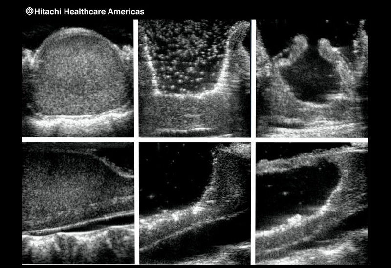 Pediatric Spinal Cord Tumor Sequence