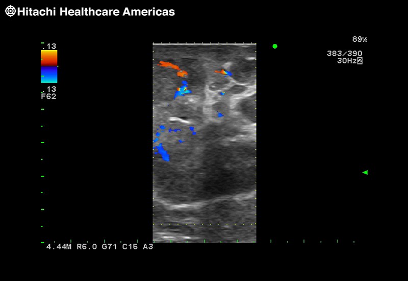 RAPN with Color Doppler