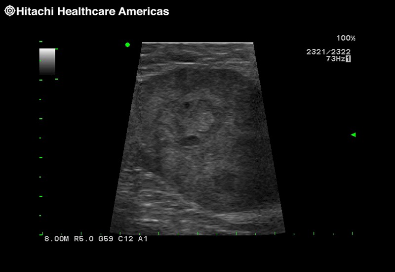 RAPN with Trapezoid Imaging
