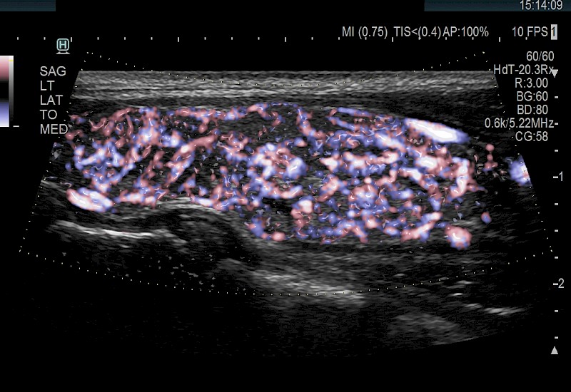 Thyroid EFlowGlossyTrapezoid 10