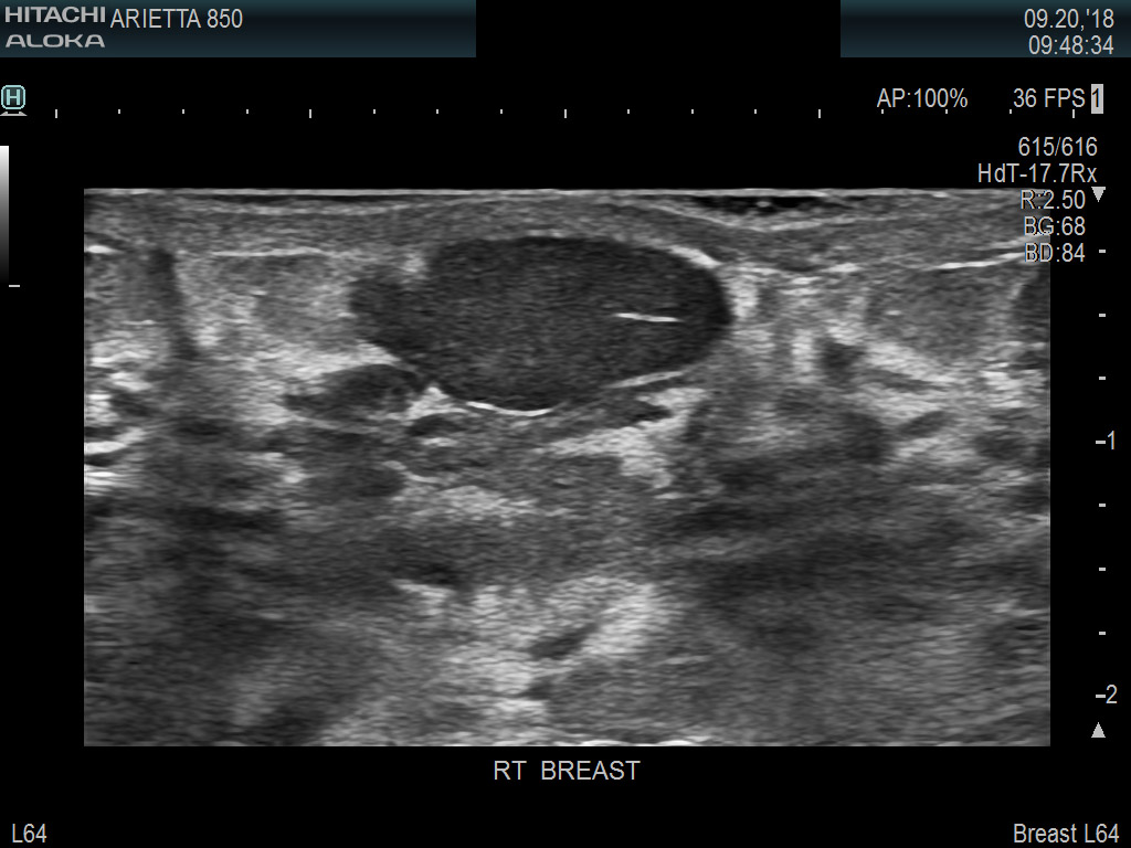 Breast Nodule SCITHI 9