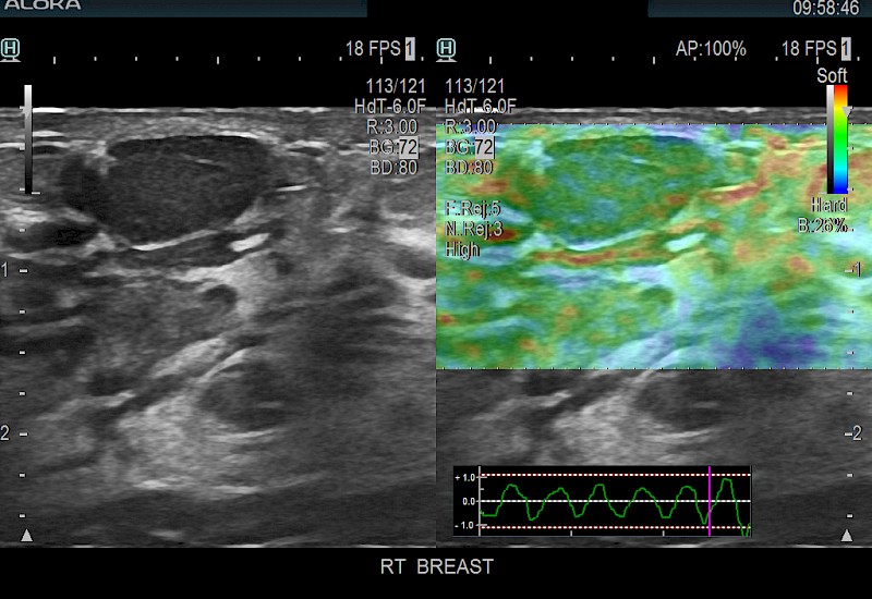 Breast Nodule Elasto 8