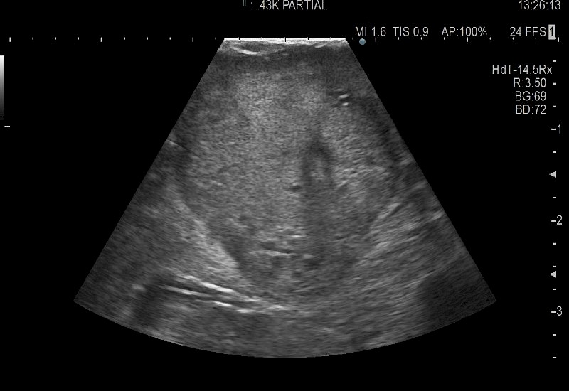 L51K Partial Nephrectomy Tumor