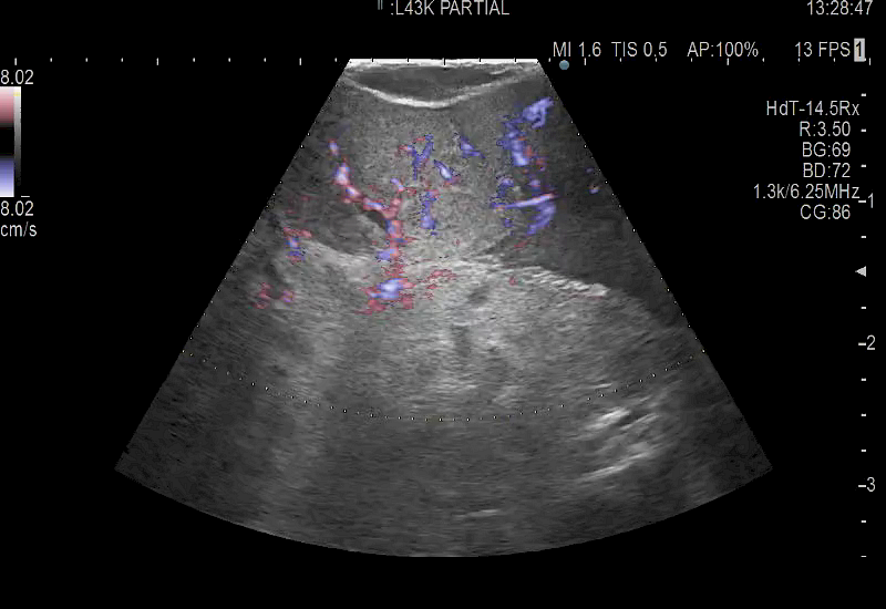 L51K Partial Nephrectomy eFlow
